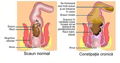 Durerile abdominale si constipatia: care sunt cauzele si cand este indicata vizita la medic?