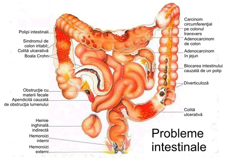 detoxifiere intestinală și intestinală